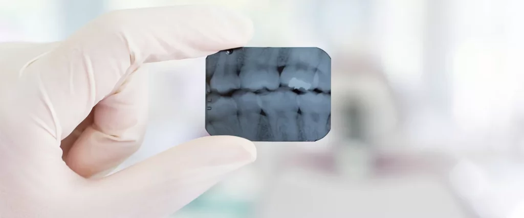 Como fazer raio-X periapical