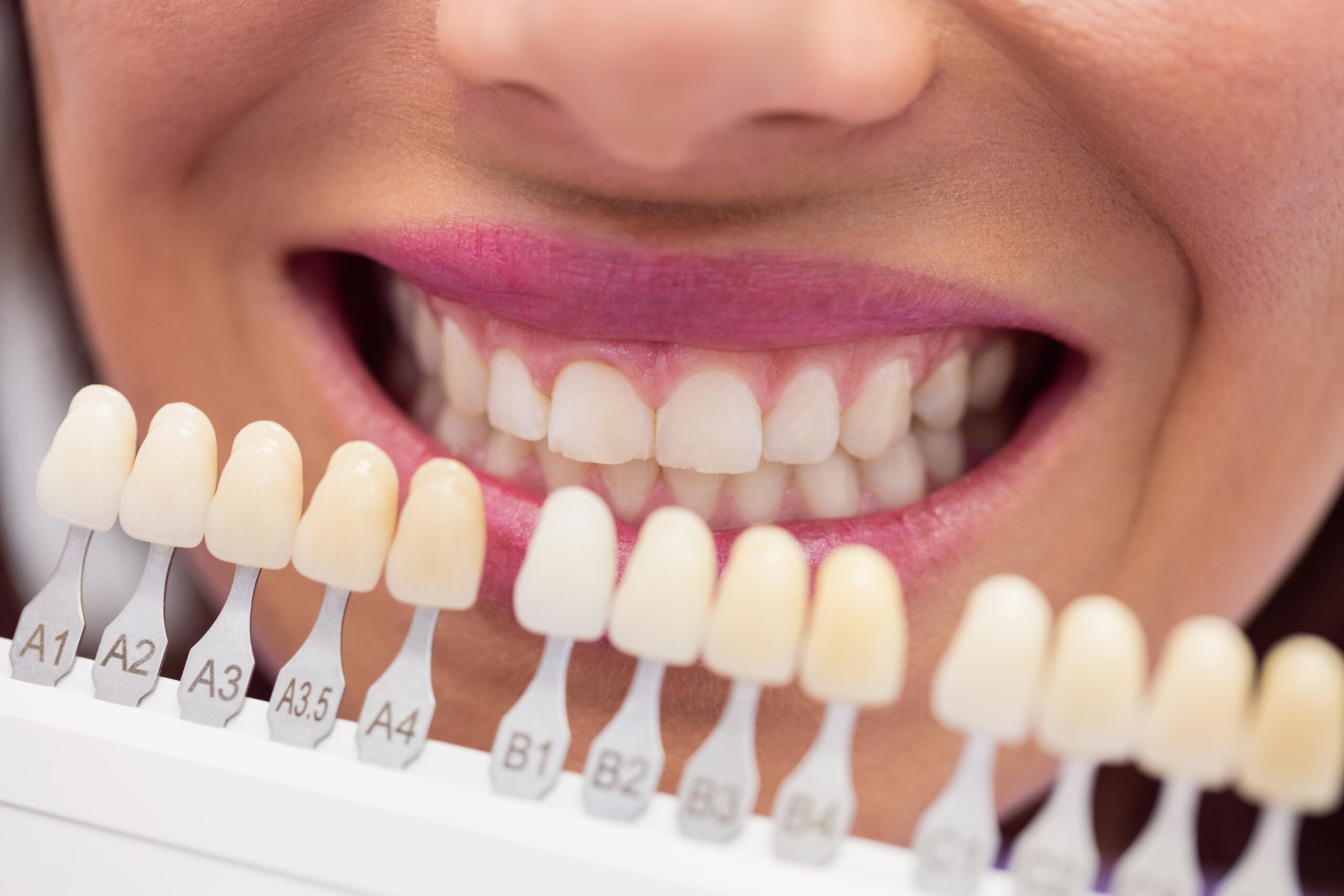 Alinhamento dos dentes: o que é e como funciona