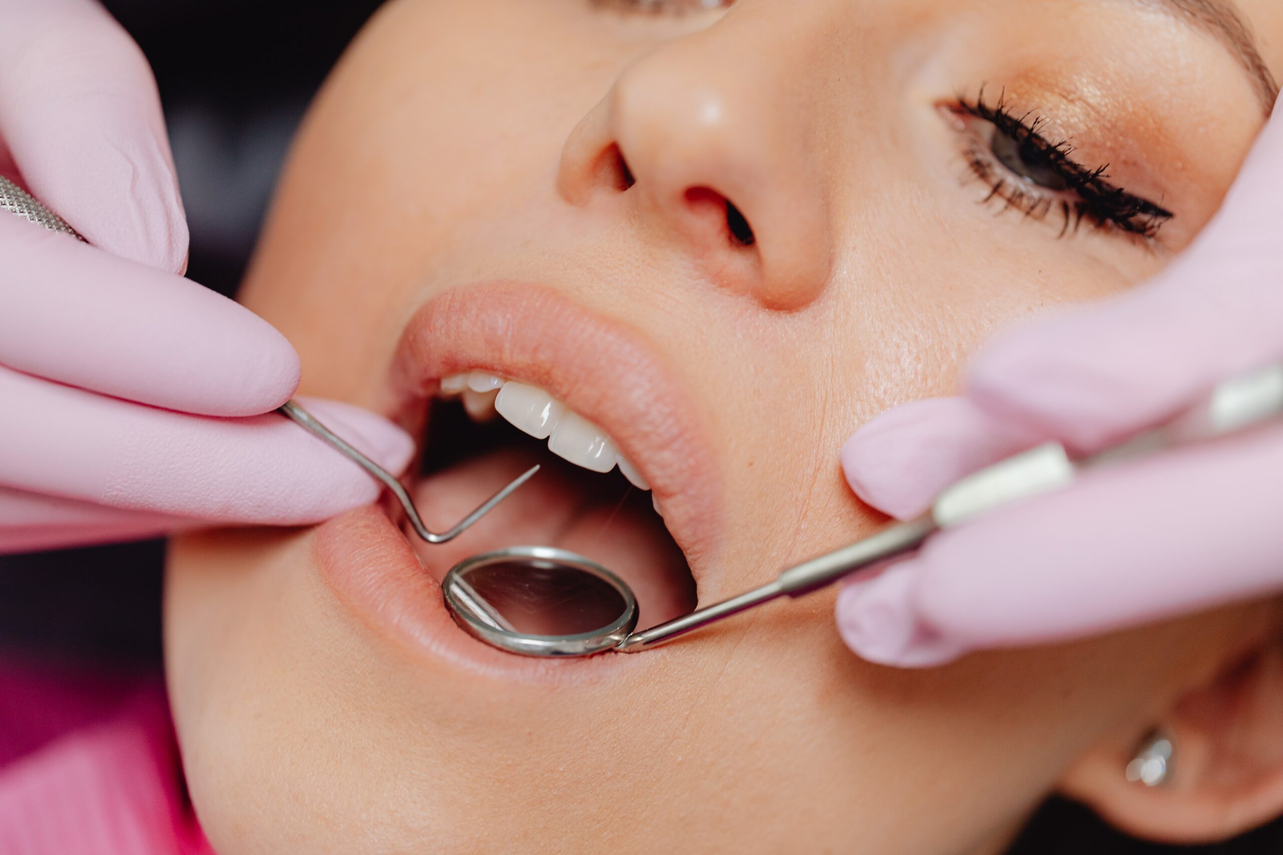 Cálculo dental: entenda sobre essa condição odontológica