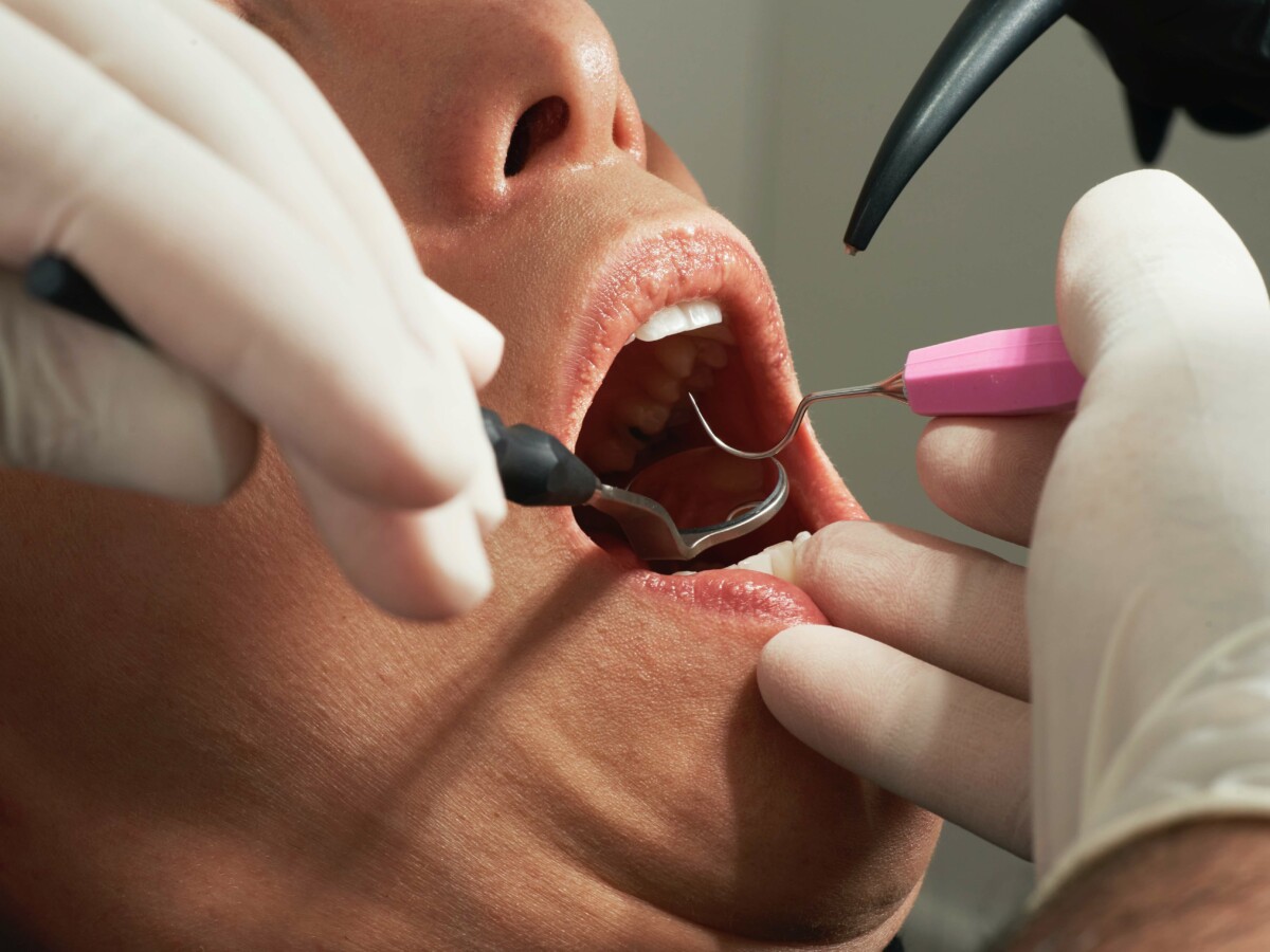 Formação de tártaro nos dentes: veja como ocorre o tratamento e 4 dicas de como evitar